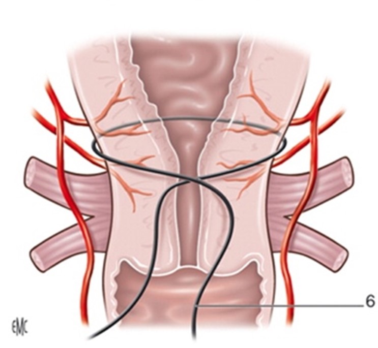 Curso Cerclaje vaginal y abdominal